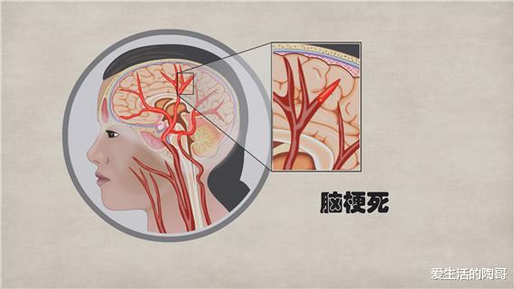 45歲男子深夜突發腦梗癱瘓醫生提醒中老年晚上少做4件事