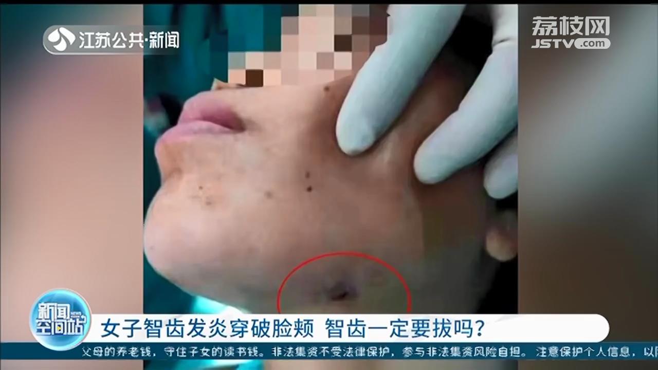 扬州女子智齿发炎硬扛好几年,左侧脸颊被脓肿穿破 智齿一定要拔吗?