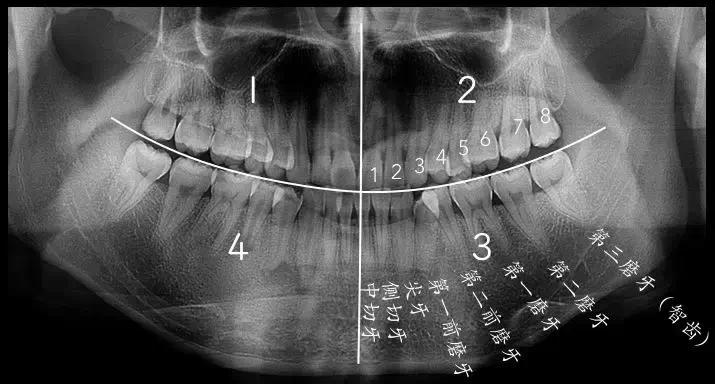 長在最後的第 8 顆牙齒,就是傳說中的「智齒」,也是我們的第三磨牙
