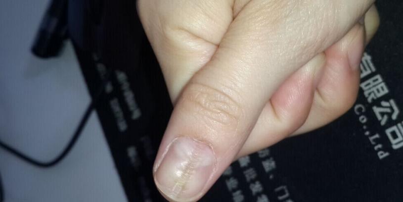 指甲出现凹凸不平的竖纹可能是4种大病要来希望你能重视
