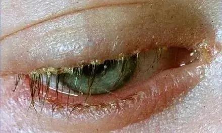 女童眼睛毛囊竟藏21条螨虫孩子眼睛出现这种症状家长要留心