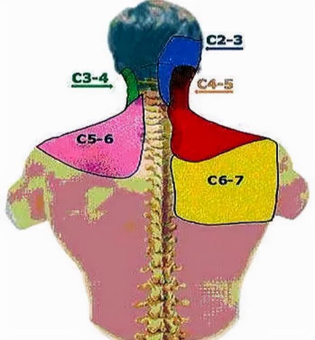 后背肩胛骨区域疼痛是怎么回事该如何应对告诉您