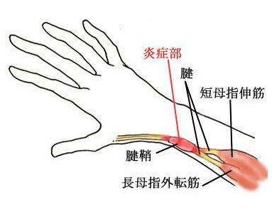 狭窄性腱鞘炎图解图片