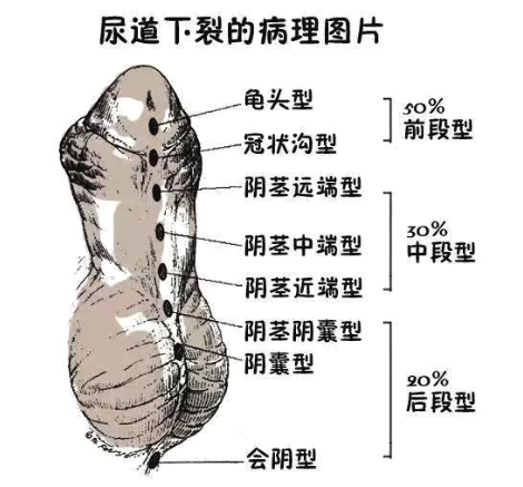 尿道下裂阴囊型图片