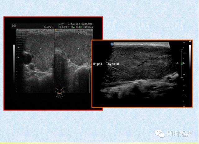 正常甲状腺彩超图片