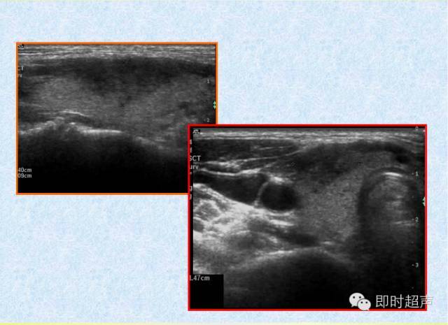 史上最實用甲狀腺超聲診斷有圖有真相