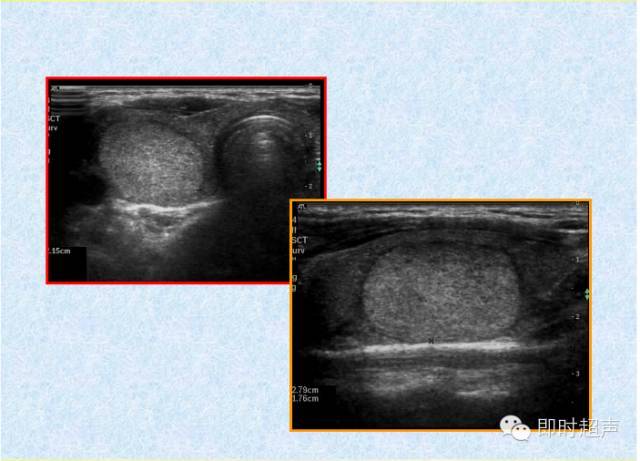 甲状腺彩超上中下极图图片