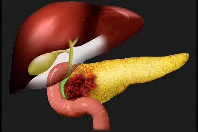 为何胰腺癌被发现时多是中晚期?杨智勇本期专家把握住胰腺生机呢?