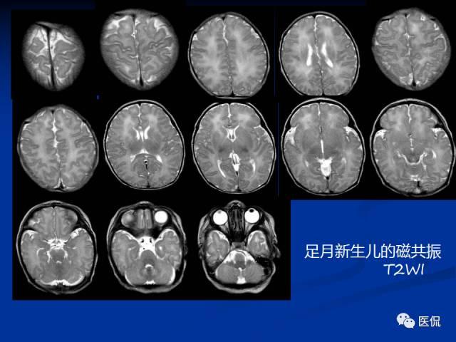 新生儿头颅ct正常图片图片