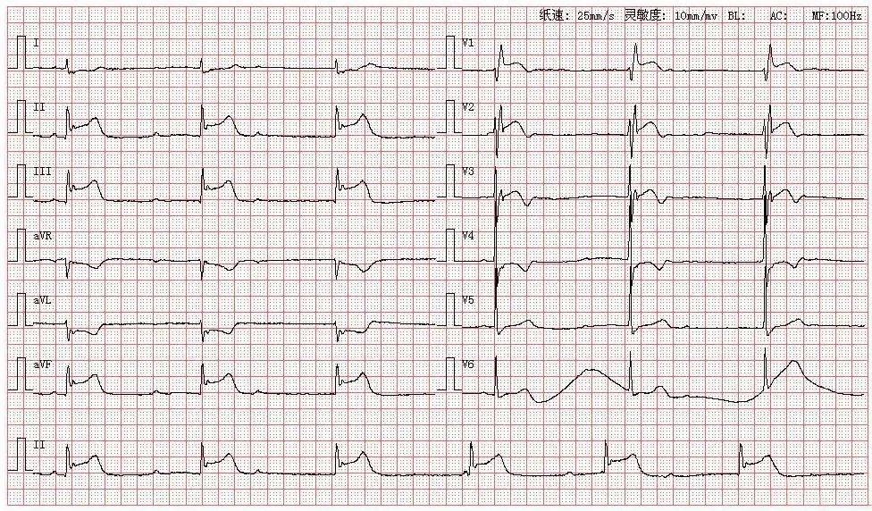 前壁心肌梗死分析:如图所示,p波在在Ⅰ,Ⅱ,avf,v4