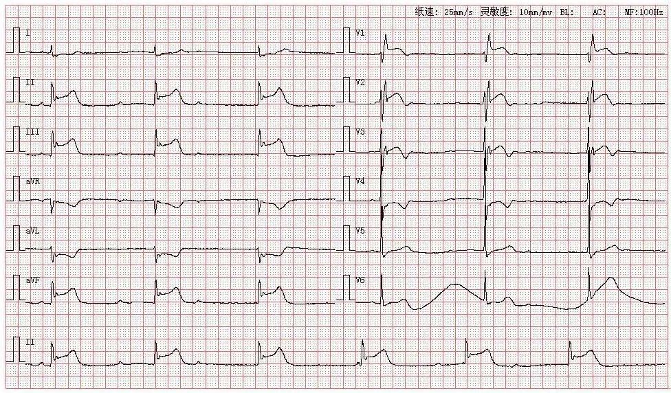 三度传导阻滞心电图图片