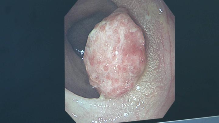 据介绍,幼年性肠道息肉病的发生和家族遗传或肠道炎症有关,医生提醒说