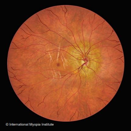 fuchs斑近视脉络膜新生血管近视新生血管性黄斑病变(myopic