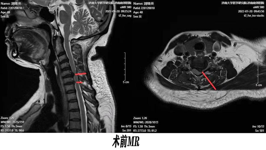 神经根型颈椎病ct图片图片