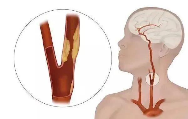 颈动脉狭窄人类健康的头号杀手