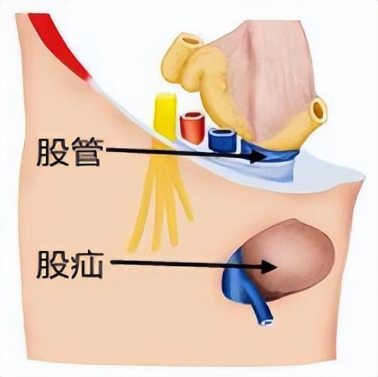 腿部疝气的症状图片图片