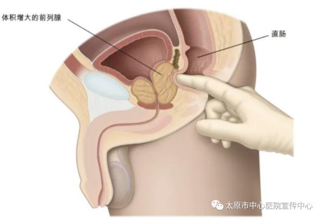 直腸指檢不可忽視的一指神功