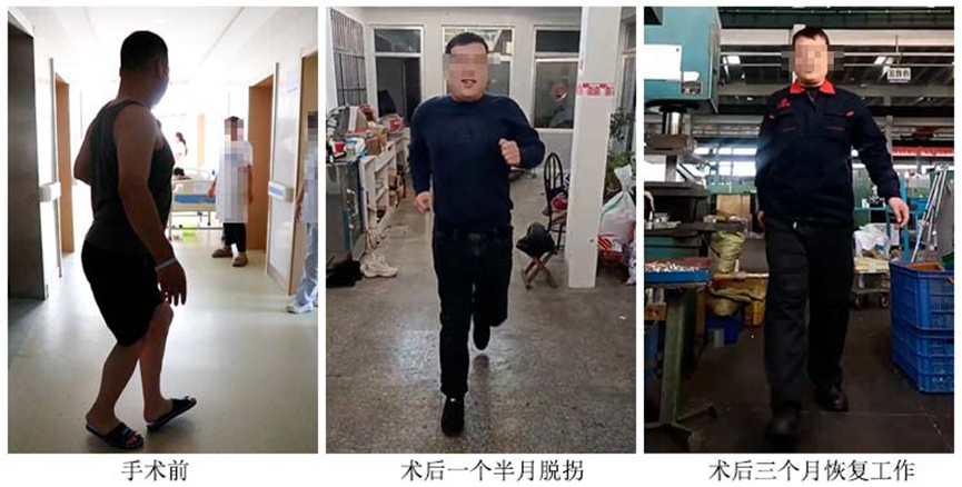 治好15年股骨头坏死，青岛小哥找回生活新希望