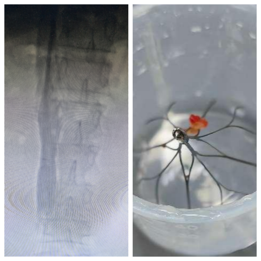 单县中心医院：血管两腺外科顺利取出患者体内超长时限滤器