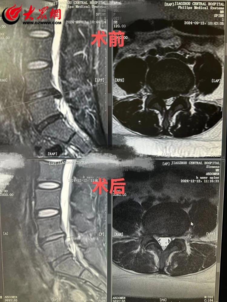 青岛市胶州中心医院根治腰椎间盘突出获锦旗